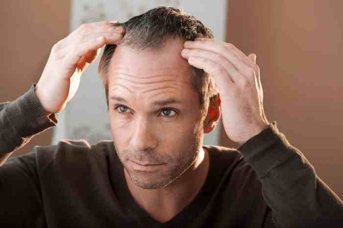 baldness male pattern hair loss mens treatment