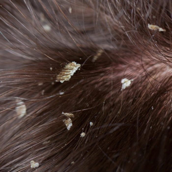 hair caredandrufffacts about dandruff