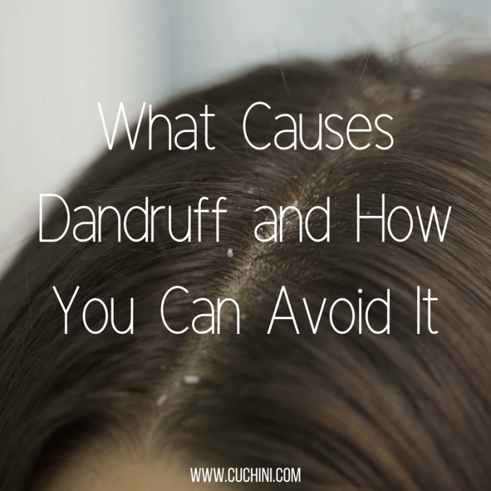what are the causes of dandruff terbaru