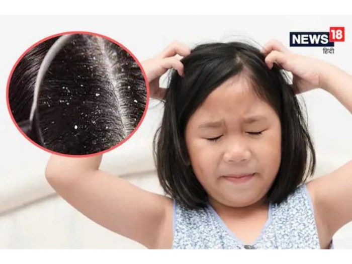 hair caredandrufffacts about dandruff terbaru