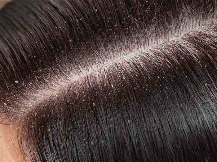what are the causes of dandruff terbaru