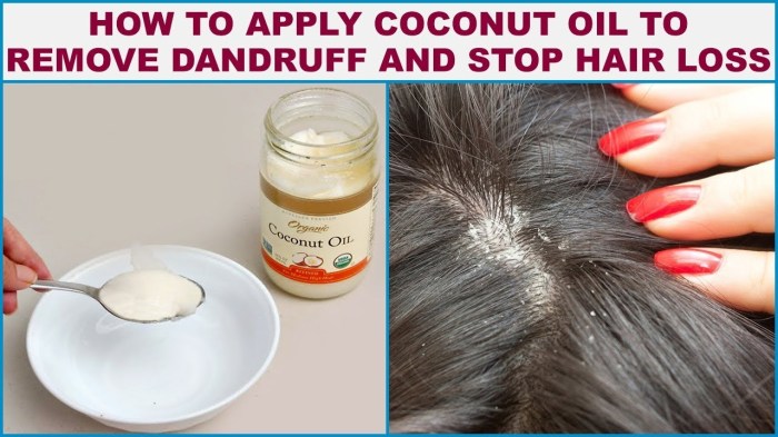 hair caredandruffhow to treat dandruff terbaru