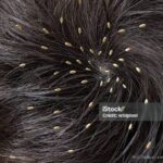 Photo via Bing Images - Panduan Efektif Menghilangkan Kutu Rambut dan Telurnya Sampai Tuntas