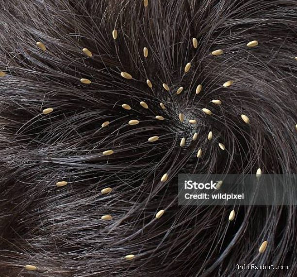 Photo via Bing Images - Panduan Efektif Menghilangkan Kutu Rambut dan Telurnya Sampai Tuntas
