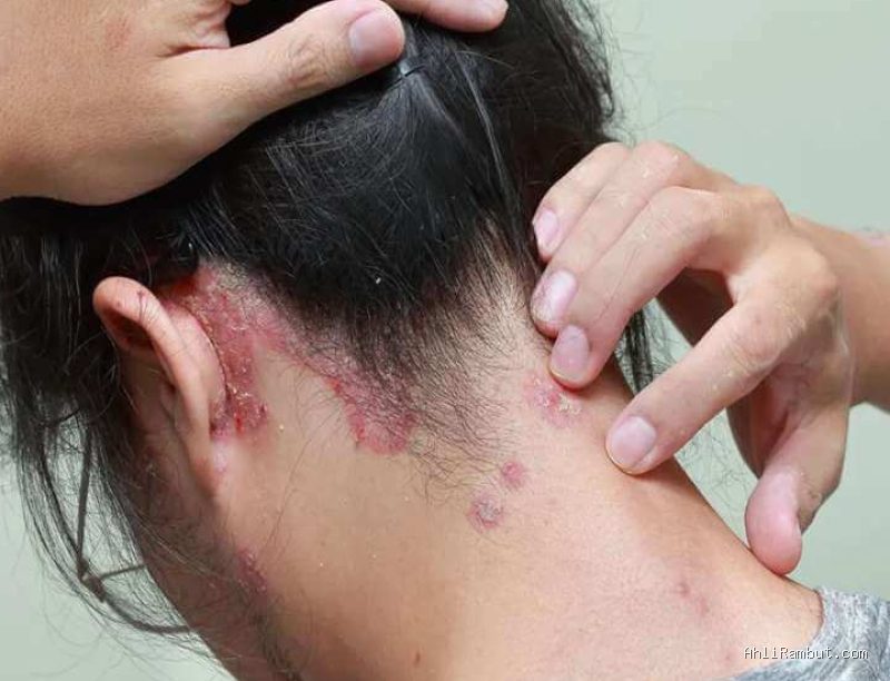 Photo via Bing Images - Penyebab Kulit Kepala Gatal dan Berkerak Meski Rutin Keramas