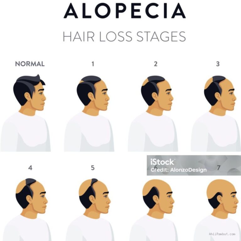 Photo by istockphoto.com - Alopecia Areata: Penyebab dan Cara Mengatasi Rambut Rontok Koin