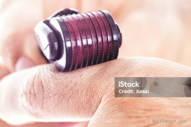 Photo by istockphoto.com - Berapa Kali Seminggu Jadwal Terbaik Pakai Dermaroller untuk Stimulasi Folikel