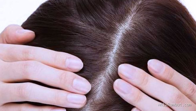 Photo by timesindonesia.co.id - Cara Menghilangkan Ketombe Tebal yang Menghambat Penyerapan Serum Rambut