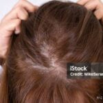 Photo by istockphoto.com - Mengatasi Rambut Tipis di Area Pusaran: Penyebab dan Solusinya