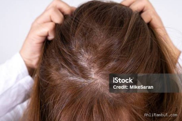 Photo by istockphoto.com - Mengatasi Rambut Tipis di Area Pusaran: Penyebab dan Solusinya