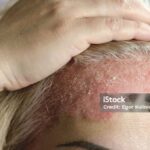 Photo by istockphoto.com - Pilihan Salep untuk Mengatasi Gatal Akibat Alergi Cat Rambut