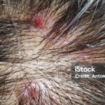 Photo by istockphoto.com - Efek Menggaruk Kulit Kepala Terlalu Keras Pakai Kuku Saat Muncul Gatal