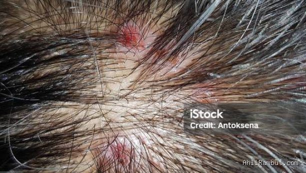 Photo by istockphoto.com - Efek Menggaruk Kulit Kepala Terlalu Keras Pakai Kuku Saat Muncul Gatal