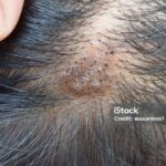 Photo by istockphoto.com - Penyebab Pori-Pori Kulit Kepala Tersumbat Minyak dan Debu Bikin Rambut Tipis