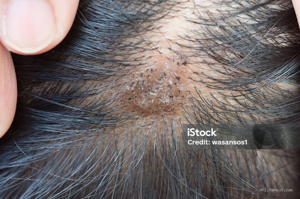 Photo by istockphoto.com - Penyebab Pori-Pori Kulit Kepala Tersumbat Minyak dan Debu Bikin Rambut Tipis