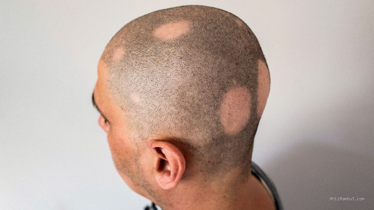 Tanda Folikel Rambut Sudah Mati Mengkilap Menjadi Jaringan Parut