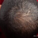 Photo by istockphoto.com - Tanda Folikel Rambut Sudah Mati Mengkilap Menjadi Jaringan Parut