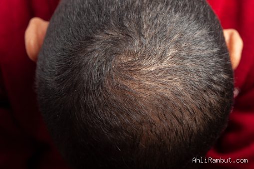 Photo by istockphoto.com - Tanda Folikel Rambut Sudah Mati Mengkilap Menjadi Jaringan Parut