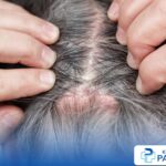 Photo by klinikpandawa.com - Tanda Kulit Kepala Mengalami Radang Folikulitis Akibat Jarum Kotor