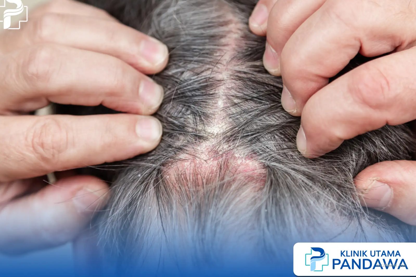 Photo by klinikpandawa.com - Tanda Kulit Kepala Mengalami Radang Folikulitis Akibat Jarum Kotor